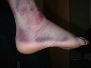 bruise on top of foot no reason